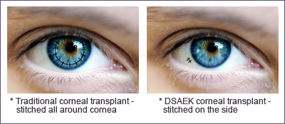 Corneal Transplant Margate