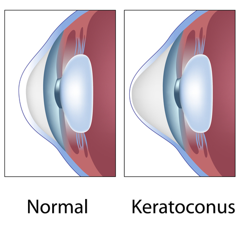 Keratoconus South Florida