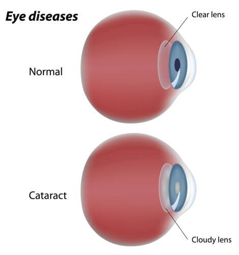 Eye Diseases South Florida