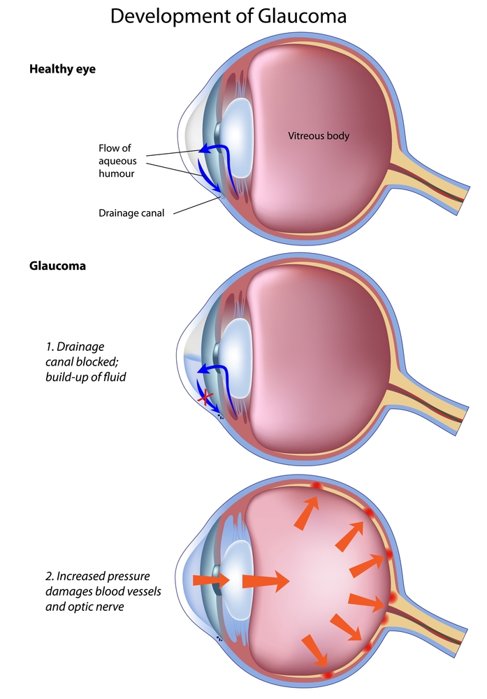 Glaucoma South Florida