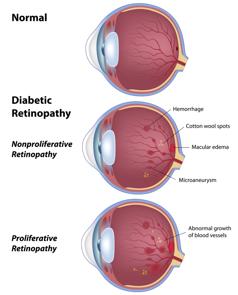 Diabetic Retinopathy South Florida