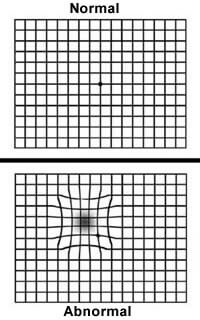 Macular Degeneration