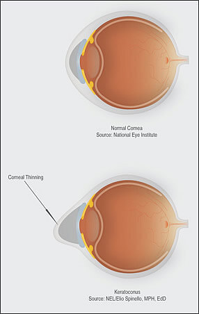 Collagen Crosslinking