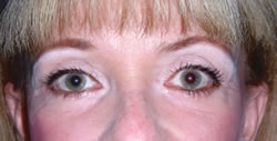 After Uneven Skin Texture