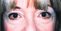 Before Uneven Skin Texture