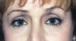 After Uneven Skin Texture