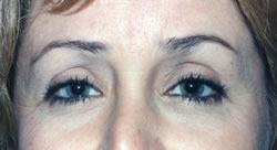 Before Uneven Skin Texture